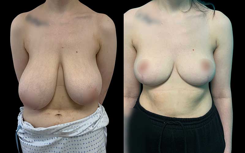 Breast Reduction Surgery in London